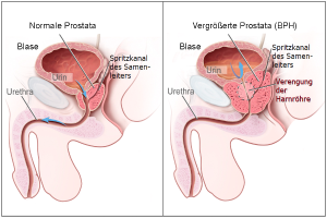 Ein Diagramm der männlichen Geschlechtsorgane mit "Prostata" und "BPH" beschriftet, das die Stadien von Prostatakrebs in verschiedenen Blauschattierungen zeigt.
