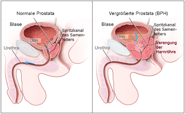 Ein Diagramm der männlichen Geschlechtsorgane mit "Prostata" und "BPH" beschriftet, das die Stadien von Prostatakrebs in verschiedenen Blauschattierungen zeigt.
